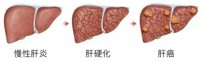 ★ NEWS ★ 近期，國內王福生院士的最新研究結果顯示，臍帶間充質幹細胞顯著改善失代償性肝硬化的肝功能及長期生存率。相關研究結果（預印本）在國際肝病學雜誌（Hepatology International）審議中。 共有219例患者納入研究，其中108名患者接受幹細胞治療，111名患者作爲對照組，並進行了長達75個月的隨訪。結果顯示，臍帶間充質幹細胞可以減輕肝素的氨基轉移，明顯改善肝臟功能，並且幹細胞治療組的總體生存率高於對照組。這一研究給間充質幹細胞治療肝硬化的安全性和有效性提供了新的證據。 01 王福生院士研究結果 研究方法：該研究納入291例失代償性肝硬化患者，分爲111人的對照組和108人的臍帶間充質幹細胞治療組，治療組每隔4周進行一次輸液，總計輸液三次。從2010年10月開始對所有患者進行持續7年的隨訪調查。 結果：治療組總生存率明顯高於對照組。從血清血蛋白、膽鹼酯酶和總膽紅素水平等指標來看，間充質幹細胞治療顯著改善了肝功能，且未觀察到明顯的副作用或治療相關併發症。 結論：間充質幹細胞治療不僅耐受性好，而且能顯著提高...