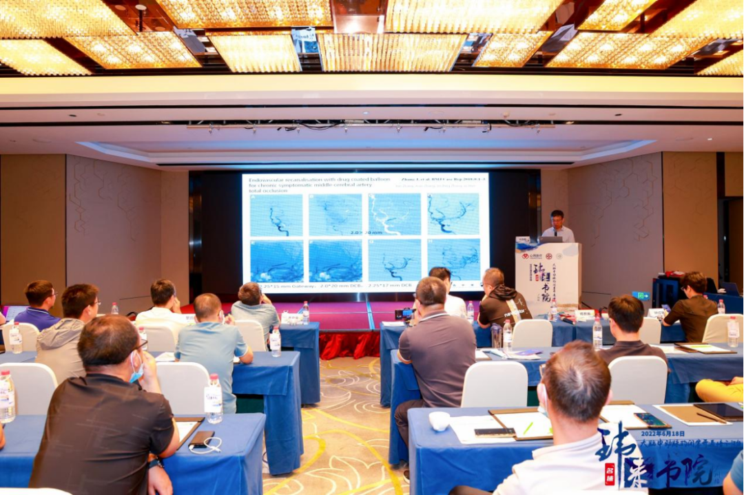 China has the highest rate of cerebrovascular disease in the world. Among them, ischemic stroke seriously threatens the lives and health of our citizens due to its high fatality rate, high disability rate, and high recurrence rate. Endovascular interventional treatment for middle cerebral artery occlusion has become an important treatment for stroke, and it is also a mountain that many cerebrovascular disease centers urgently need to climb. In order to improve the level of occlusion and opening of arteries in the middle of the brain in the field of neurological intervention, we will promote the development of interventional neurological diagnosis and treatment in our province. Led by Professor Pan Suyue and Professor Ji Zhong of Nanfang Hospital Stroke Center & Neurointerventional Training Center, it was co-planned with Xin Wei Medical“Weilai Academy - Opening Course on Middle Cerebral Artery Occlusion”It was also successfully held at Guangzhou Nanhu Holiday Hotel on June 18, 2022. The training course invited a number of well-known experts in neurological intervention, neuroimaging, neuroultrasound, etc. from inside and outside Guangdong Province to give lectures and guidance. Through various forms such as surgical techniques, strategy analysis, actual practice sharing, and case review, they shared their valuable experience in opening artery occlusion in the middle of the brain. Through in-depth discussions and exchanges in this training course, we brought new clinical ideas and surgical initiation techniques to our neurointerventional colleagues who participated in the training course. Professor Pan Suyue, director of the Department of Neurology at Nanfang Hospital, gave an opening speech to kick off this training course. Professor Pan Suyue and Mr. Yu Feng of Xin Wei Medical jointly held an unveiling ceremony for the “Weilai Academy - National Standardized Stroke Diagnosis and Treatment Training Center”. First half of academic teaching In the academic teaching of the training course...