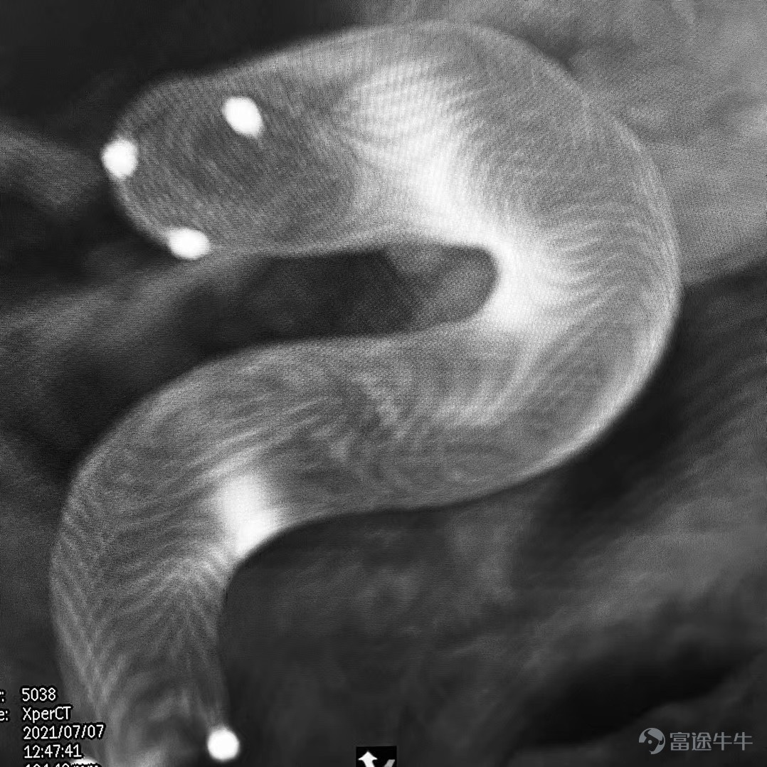 Professor Liu Jianmin's team from Changhai Hospital completed the first clinical trial of the “Tongqiao Kirin” blood flow guide device