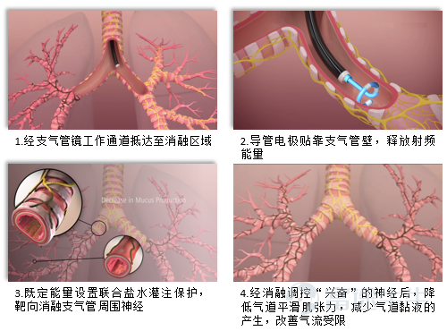 New Year's Good News |堃博医疗's Self-developed Targeted Pulmonary Radiofrequency Ablation System (BroncTarget®) Enters the Special Review Channel for Innovative Me...